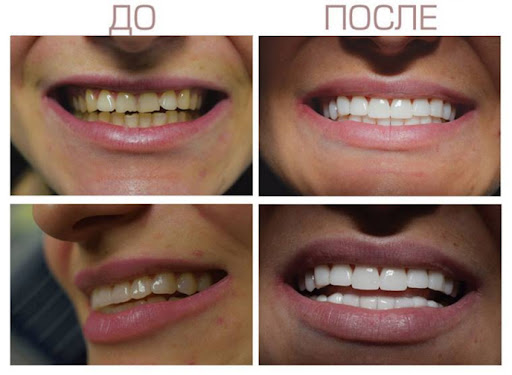 Эстетическая реставрация зубов: возвращение к улыбке