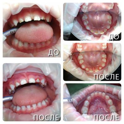 Как проводится лечение зубов под наркозом