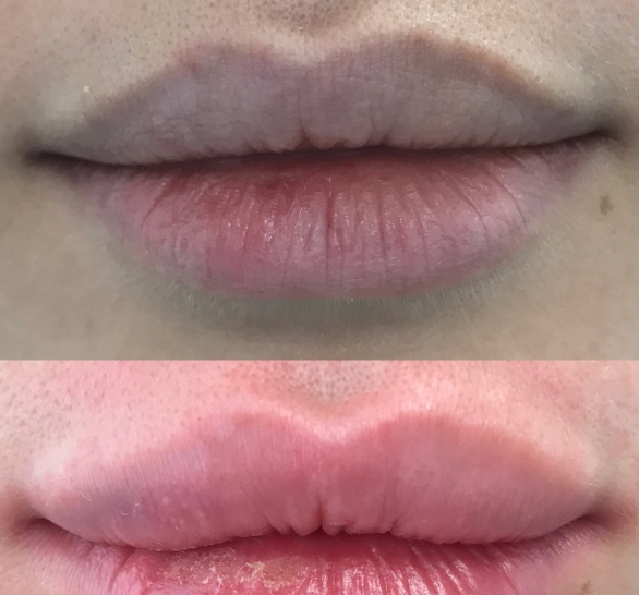 Биоревитализация губ: восстановление природной красоты