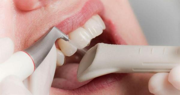 Чистка зубов Air Flow: Инновационный подход к здоровью улыбки