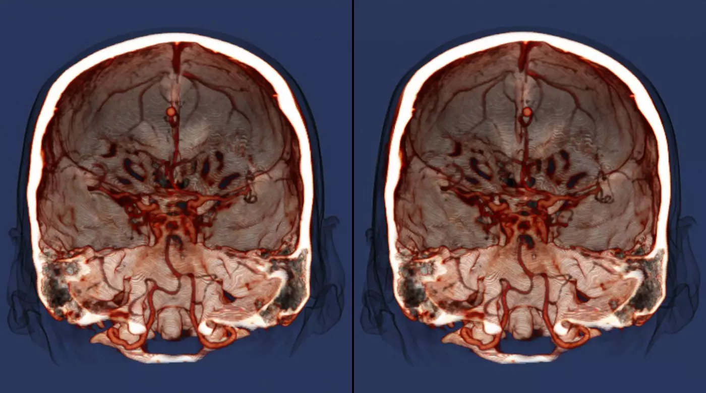 Преимущества МРТ головного мозга исследования