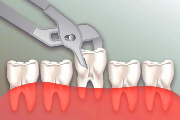 Удаление Зуба с Флюсом: Процедура, Показания