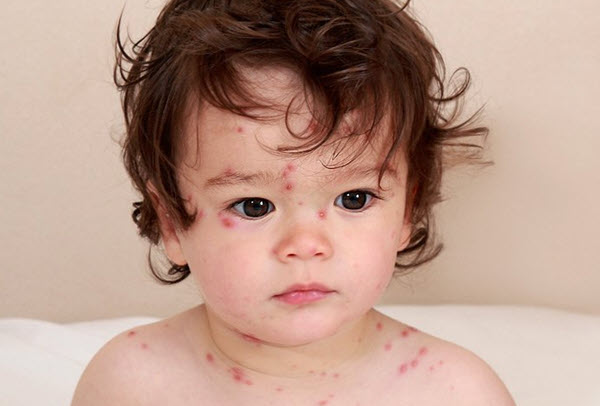 Сыпь на теле у ребенка - фото с пояснениями