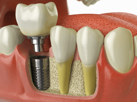 Имплантация зубов позволяет полностью вернуть функциональность