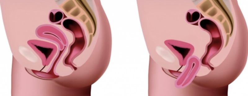 Опущение матки 1 степени - от симптомов до лечения